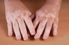 Vitiligo Kebanyakan...