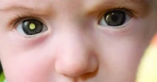 Apa Itu Retinoblastoma?...