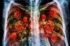 5 Fakta Pneumonia, Penyakit...