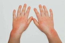 Mengenal Penyakit Scabies...