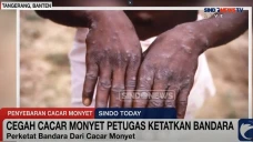 Cegah Penyebaran Cacar...