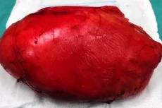 OMG, Tumor Seberat 5...