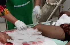 Diterkam Buaya Ganas, Kaki Pria Asal Banten Ini Nyaris Putus