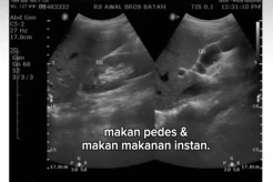 Kisah Pilu Wanita Idap Polip Empedu Akibat Sering Makan Pedas dan Instan