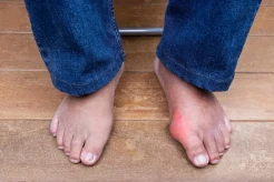 Penyebab Asam Urat di Usia Muda, 5 Kebiasaan Buruk Ini Harus Dihindari