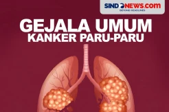 Gejala Kanker Paru yang Tak Disadari Seperti Diidap Kiki Fatmala
