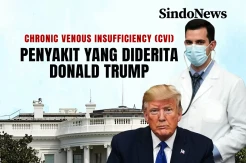 Chronic Venous Insufficiency, Penyakit yang Diderita Donald Trump