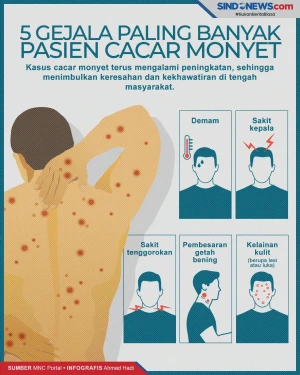 Ini 5 Gejala Cacar Monyet...