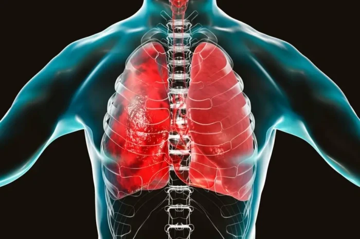 Epidemiolog Sebut Pneumonia...