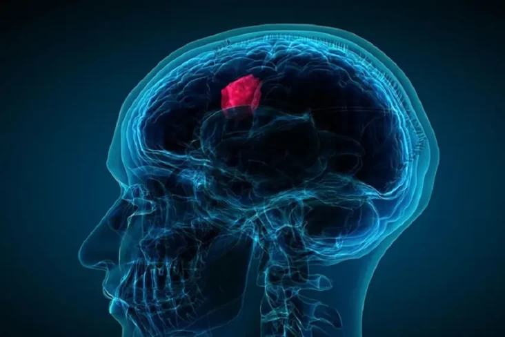 2 Gejala Awal Tumor...