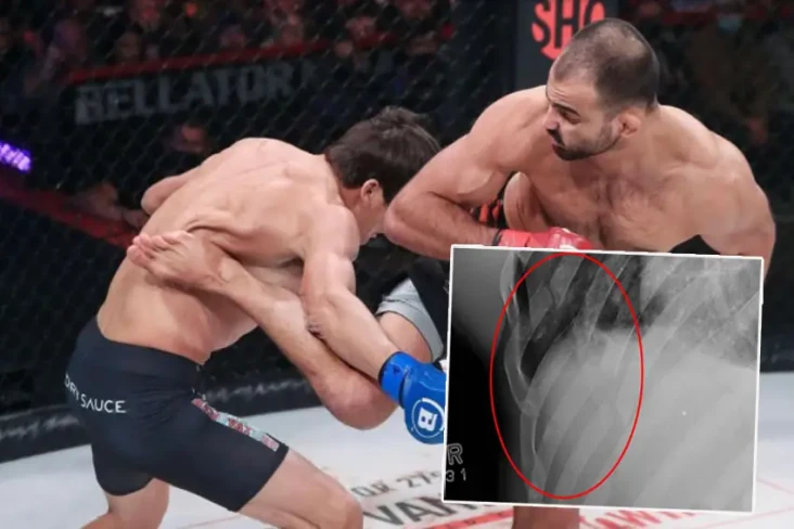 Brutal! 5 Tulang Rusuk...