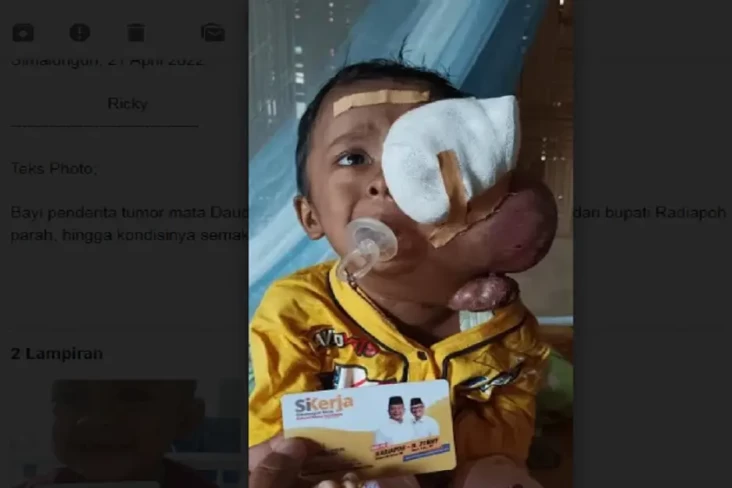 Bayi Penderita Tumor...