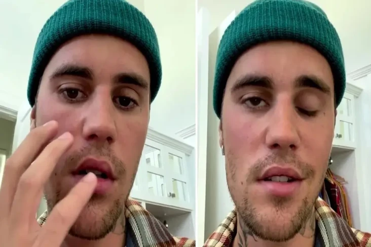 Justin Bieber Idap Ramsay...