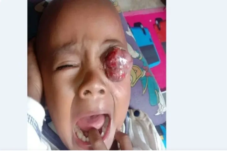 3 Tahun Menderita Tumor...