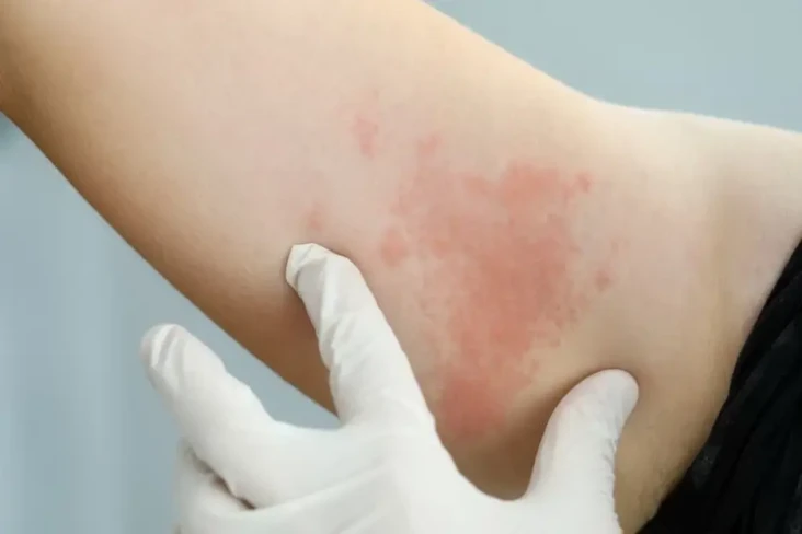 Aquagenic Urticaria,...