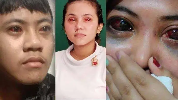 Rekam Medis Beda Mata...