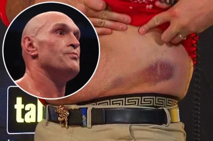 Pinggang Tyson Fury...