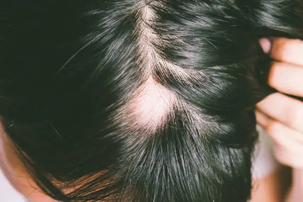 Mengenal Penyebab Alopecia...