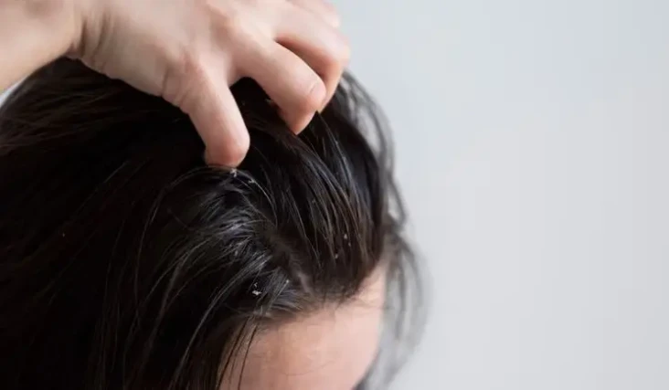 5 Penyebab Rambut Gatal...