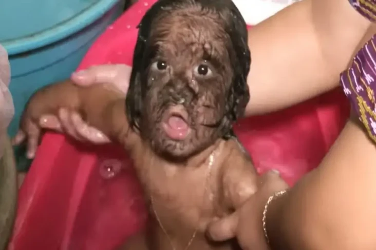 Penyakit Langka, Gadis...
