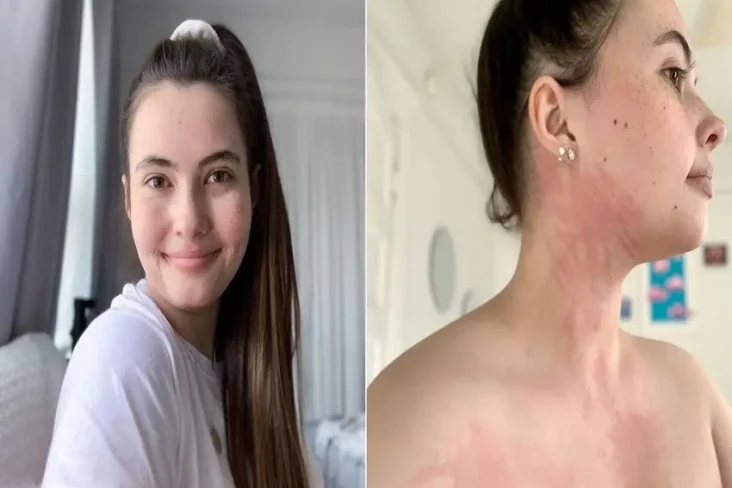 Wanita Ini Alergi terhadap...