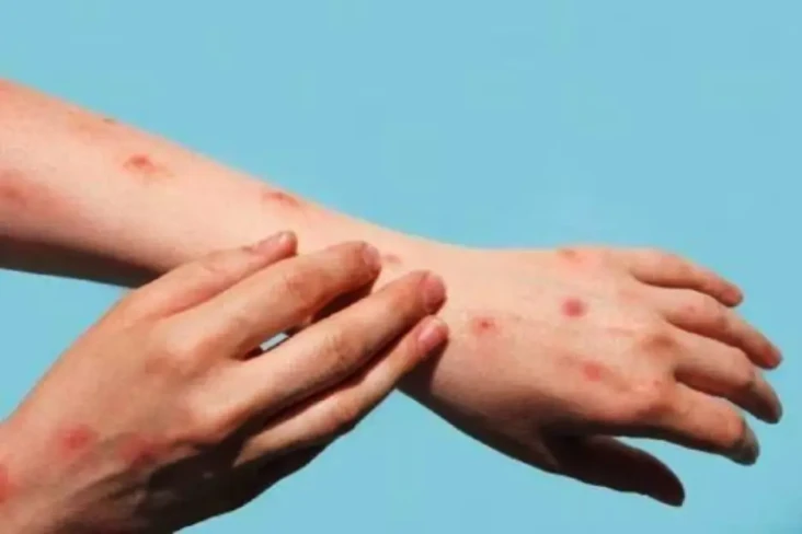 Virus Cacar Monyet Masuk...
