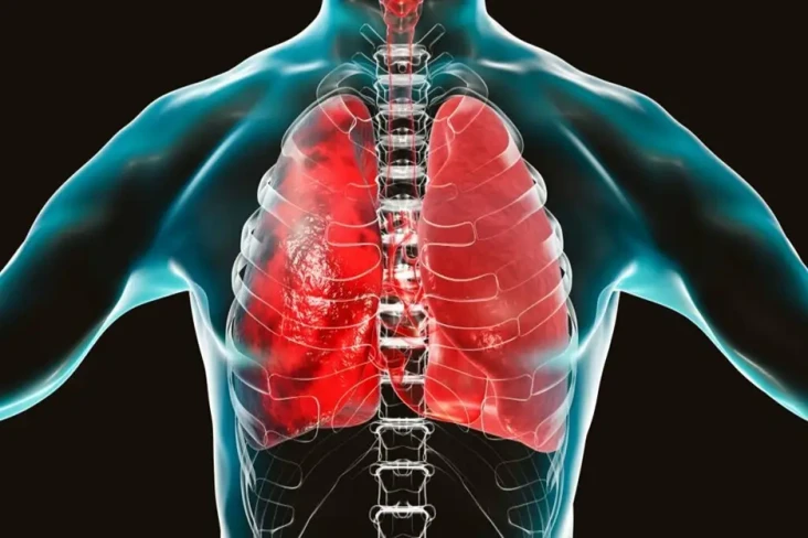 Epidemiolog Sebut Pneumonia...
