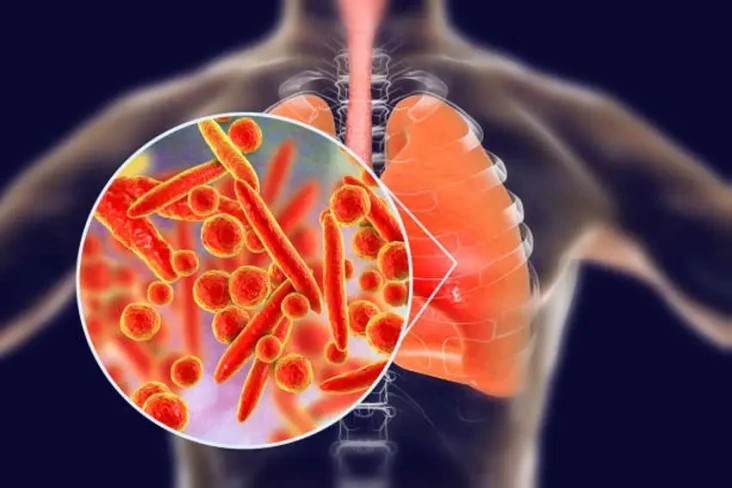 Mycoplasma Pneumonia...