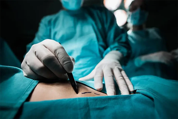 Apa Itu Liposuction,...
