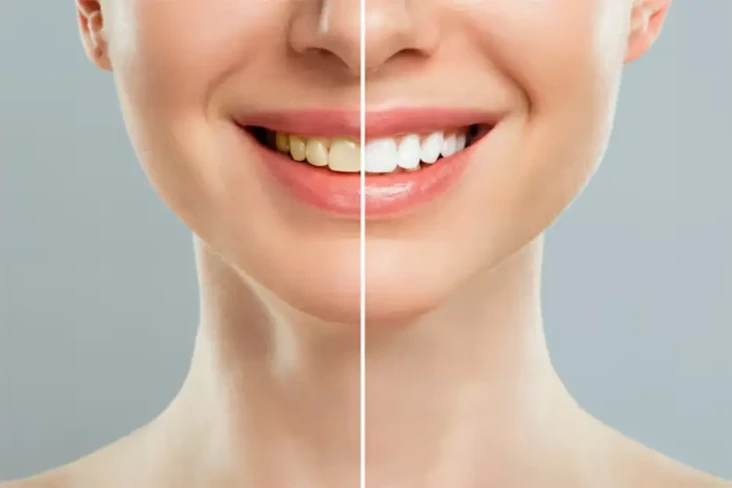 Proses dan Efek Bleaching...