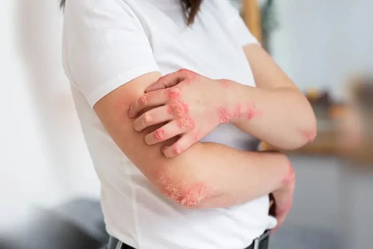 Kenali Ringworm, Penyakit...