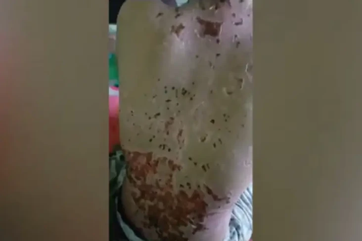 Ngeri! Siswi SMP Melepuh...