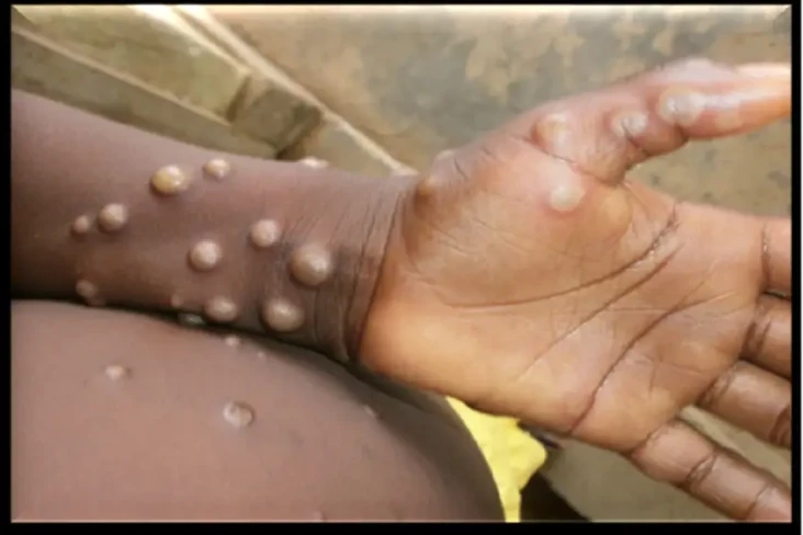 Wabah Monkeypox Dinyatakan...