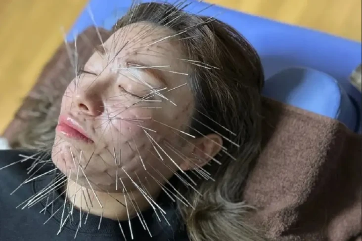 Viral! Akupunktur Tusuk...