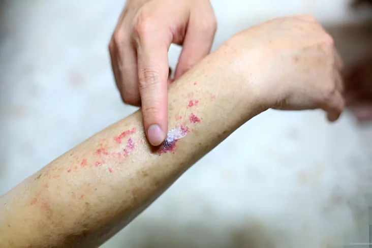 6 Gejala Diabetes pada...