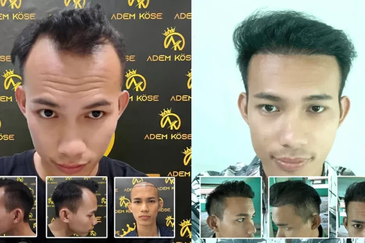 Ademkose Hair Transplant...