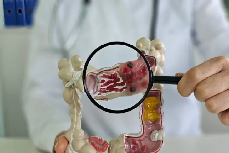 Kanker Usus Besar Mulai...