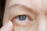 Mengenal Ptosis, Kondisi...