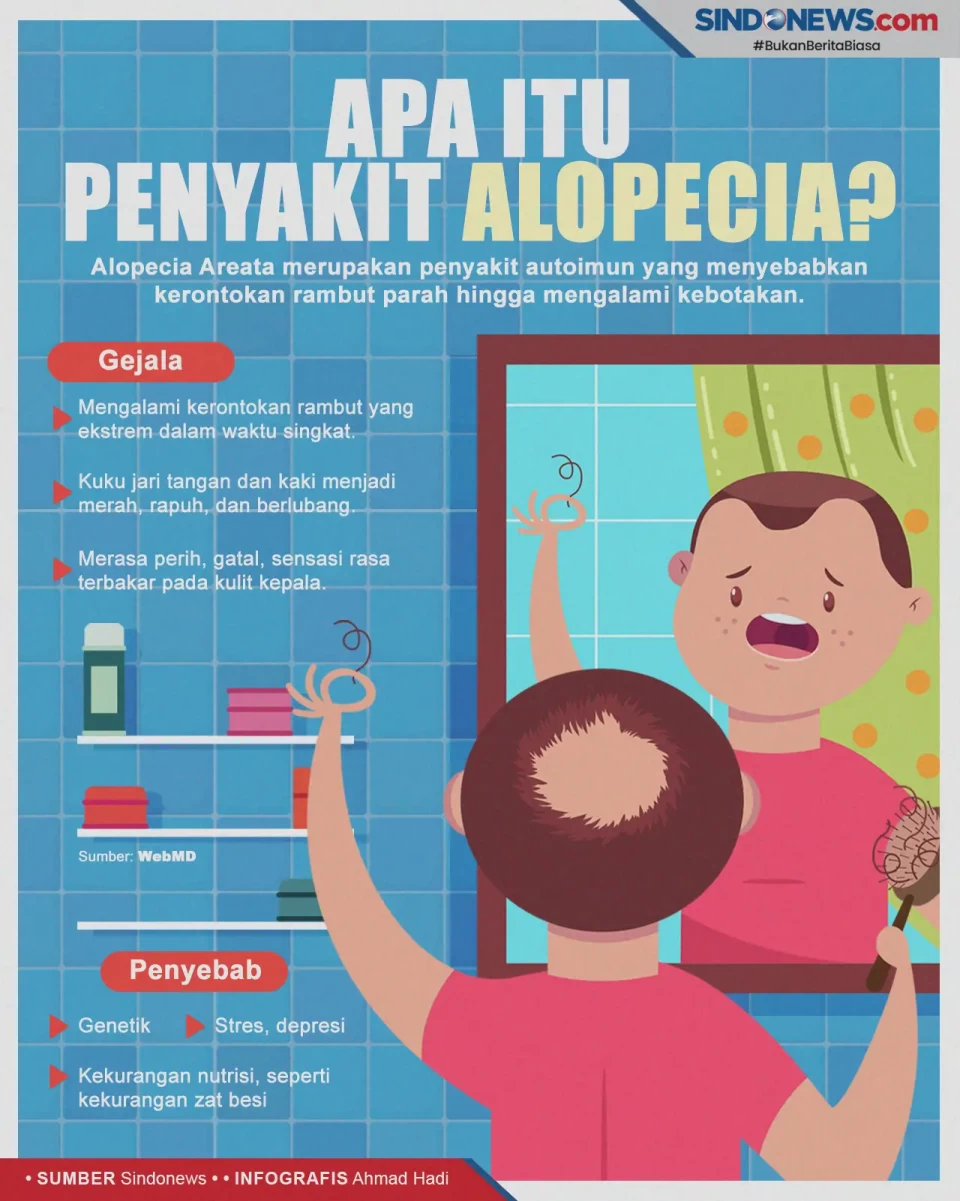 Mengenal Alopecia, Penyakit...