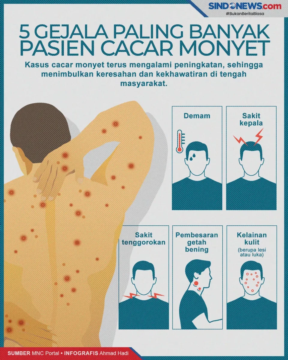 Ini 5 Gejala Cacar Monyet...