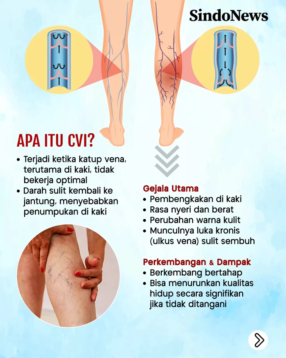 Chronic Venous Insufficiency,...
