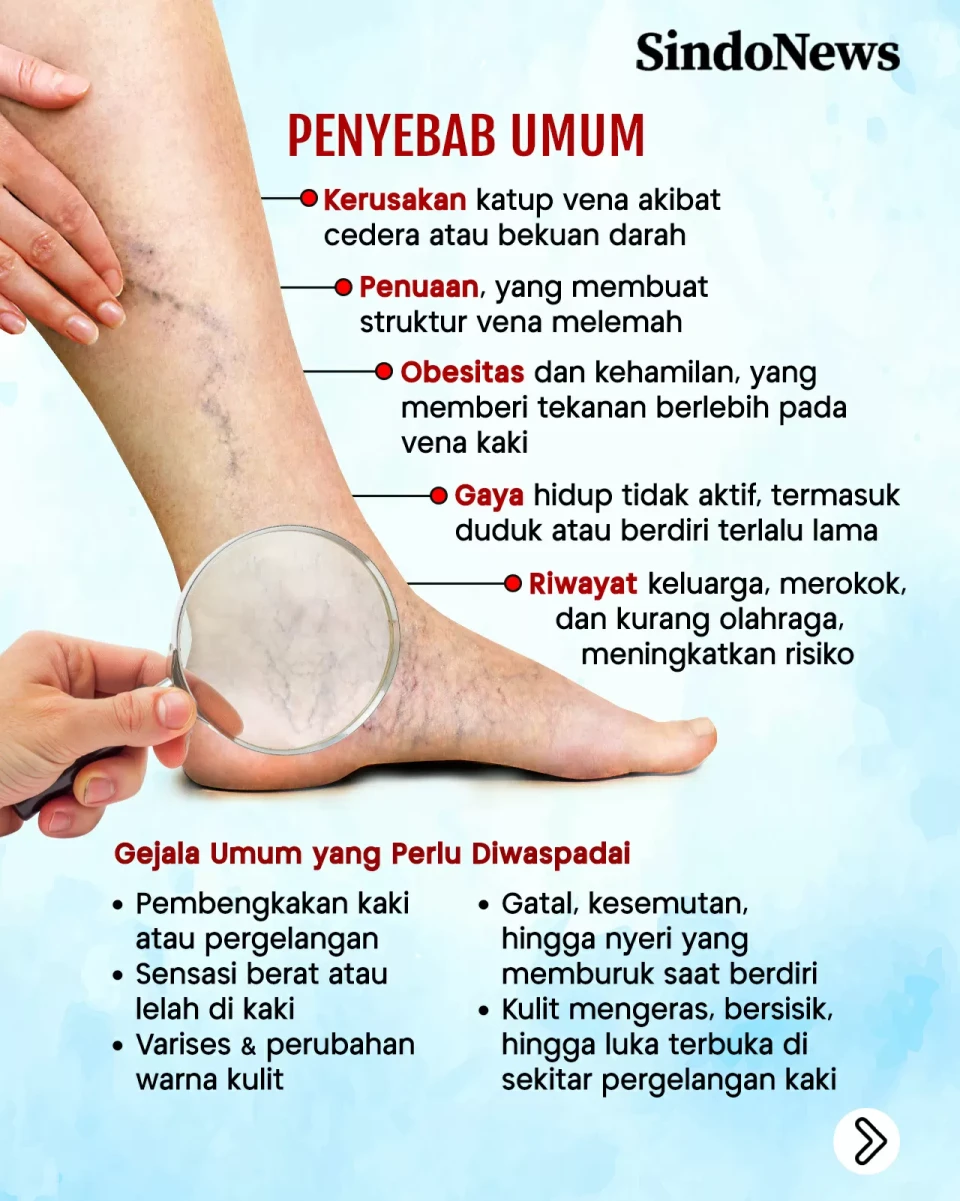 Chronic Venous Insufficiency,...
